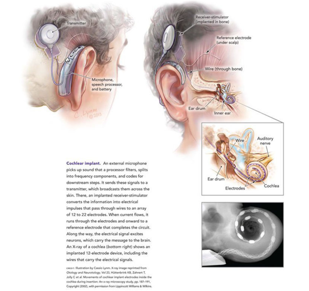 Fully Internal Cochlear Implant – QPZO